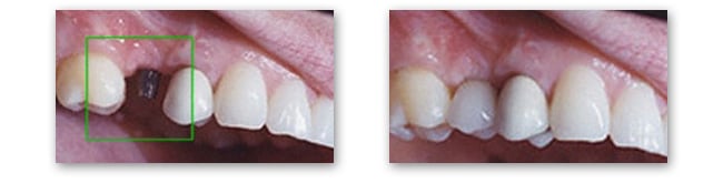 Dental implants in Norman OK give you back your natural looking smile 