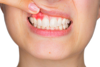 Woman with gum irritation for gum disease in Norman OK