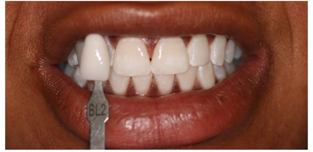 A patient being shown a shade guide for a porcelain veneer.