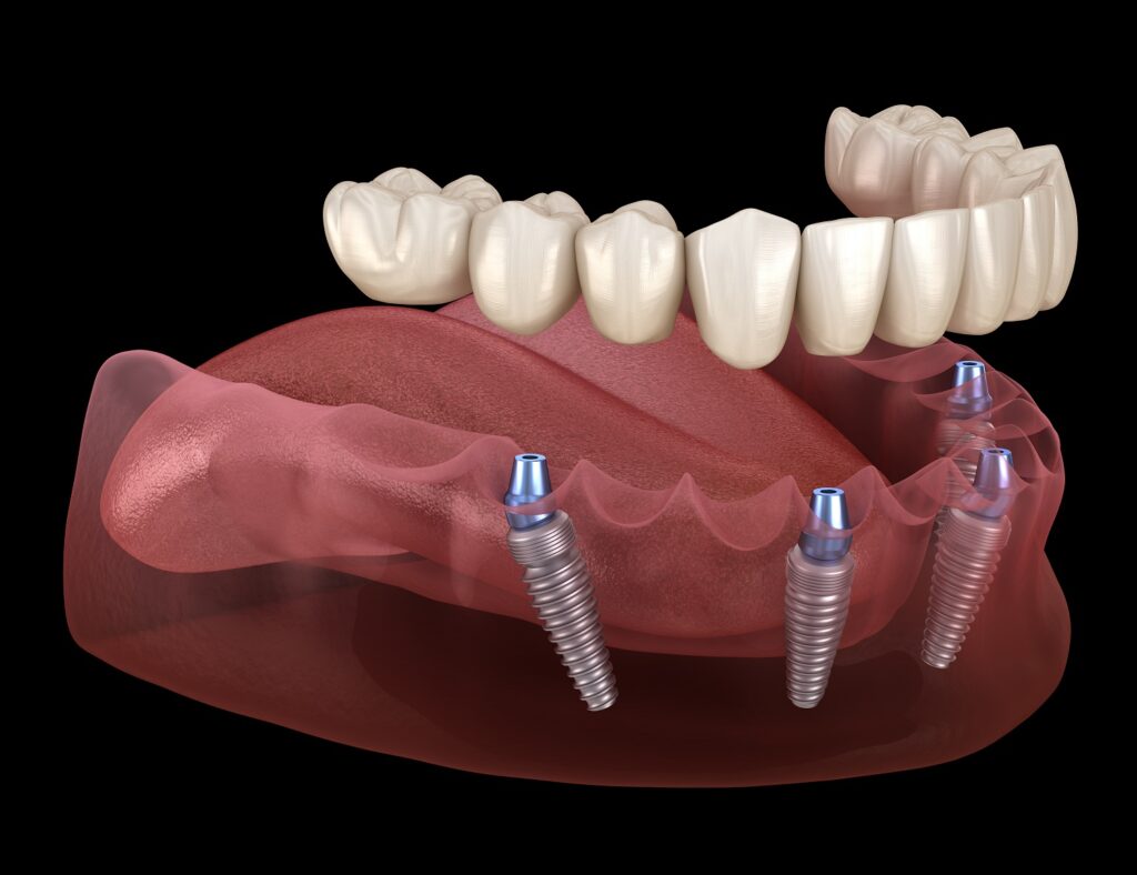 All-on-X Denture Implants
